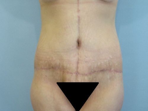 Tummy Tuck | 360 Body Lift Before and After case 3