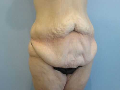 Tummy Tuck | 360 Body Lift Before and After case 3