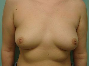 Breast Augmentation Before & After case 12