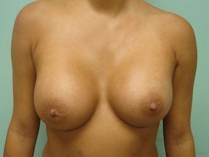 Breast Augmentation Before & After case 16