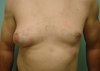 Gynecomastia Before & After case 3