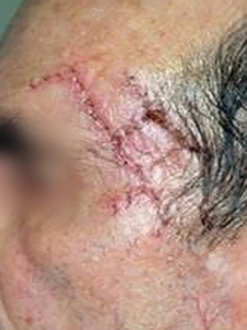 Skin Cancer Before & After case 2