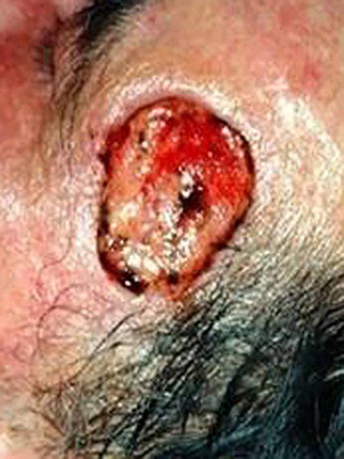 Skin Cancer Before & After case 2