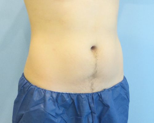 Smart Liposuction Before & After case 3