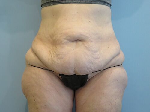 Tummy Tuck | 360 Body Lift Before & After case 10