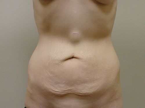 Tummy Tuck | 360 Body Lift Before & After case 22