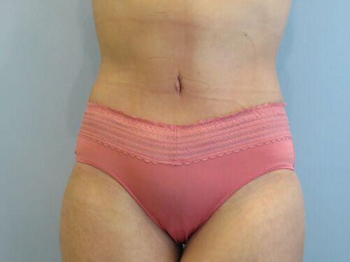 Tummy Tuck | 360 Body Lift Before and After case 9