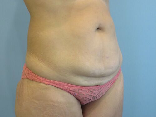 Tummy Tuck | 360 Body Lift Before and After case 9