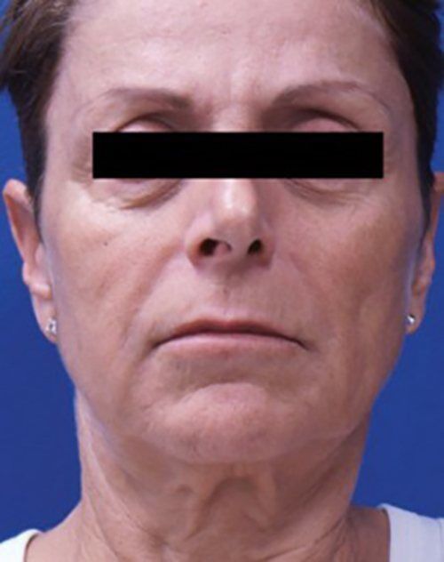Venus Freeze Before & After Case 1