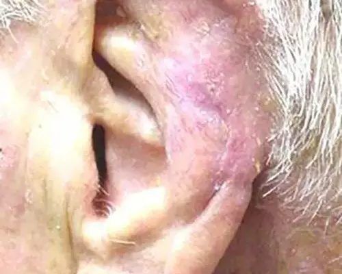 Skin Cancer Before & After