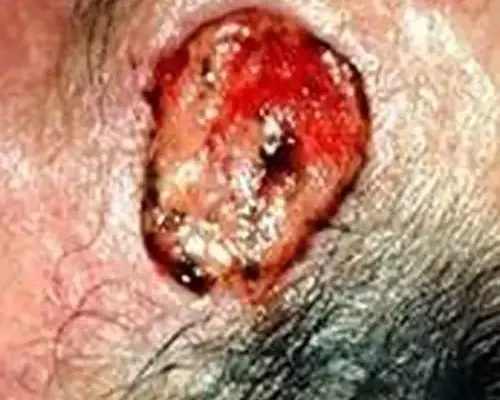 Skin Cancer Before & After